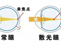 眼睛有散光是怎么样的眼，眼睛有近视和散光怎样才能恢复正常