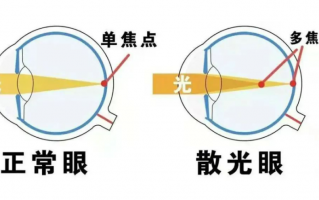 眼睛有散光是怎么样的眼，眼睛有近视和散光怎样才能恢复正常
